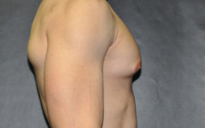 Gynecomastia Before and After Pictures Plano, TX