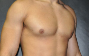 Gynecomastia Before and After Pictures Plano, TX