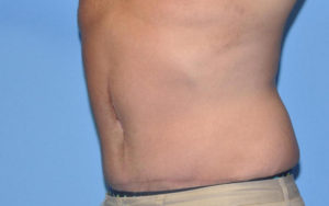 Tummy Tuck Before and After Pictures Plano, TX