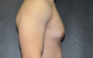 Gynecomastia Before and After Pictures Plano, TX