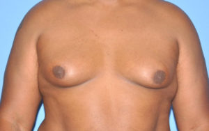 Before After Gynecomastia Plano