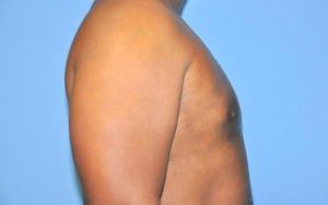 Before After Gynecomastia Plano