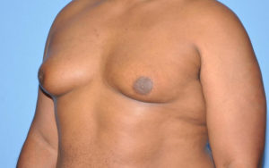 Before After Gynecomastia Plano