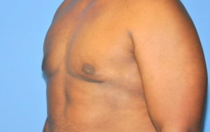 Before After Gynecomastia Plano