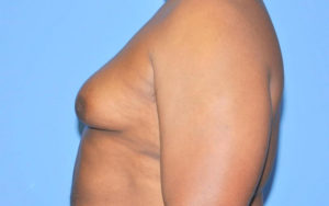 Before After Gynecomastia Plano