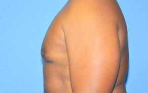 Before After Gynecomastia Plano