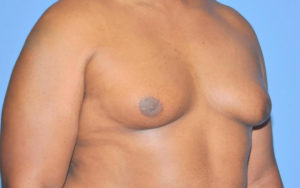 Before After Gynecomastia Plano