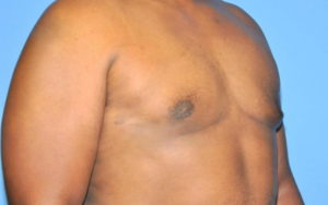 Before After Gynecomastia Plano