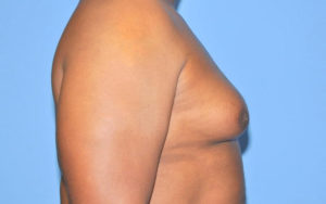 Before After Gynecomastia Plano