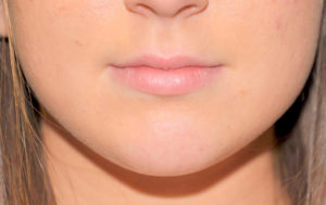 Injectables/Fillers Before and After Pictures Plano, TX