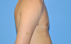 Before After Gynecomastia Plano