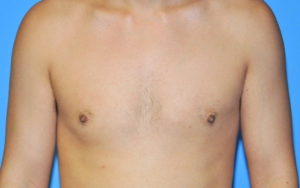 Before After Gynecomastia Plano