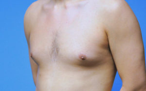 Before After Gynecomastia Plano