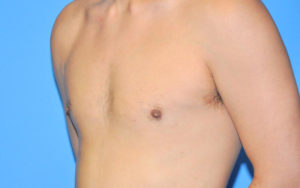 Before After Gynecomastia Plano