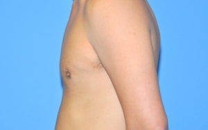 Before After Gynecomastia Plano