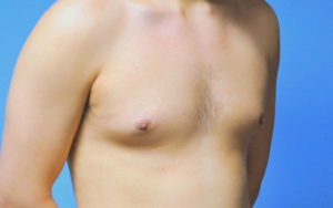 Before After Gynecomastia Plano