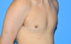 Before After Gynecomastia Plano