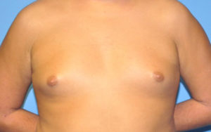 Before After Gynecomastia Plano