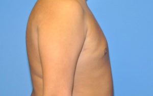 Before After Gynecomastia Plano