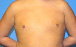 Before After Gynecomastia Plano