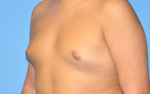 Before After Gynecomastia Plano