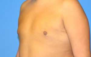 Before After Gynecomastia Plano