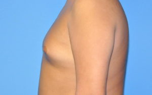 Before After Gynecomastia Plano