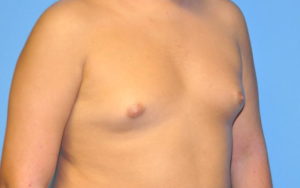 Before After Gynecomastia Plano