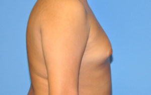 Before After Gynecomastia Plano