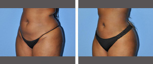 Liposuction Before and After Pictures Plano, TX