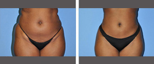 Liposuction Before and After Pictures Plano, TX